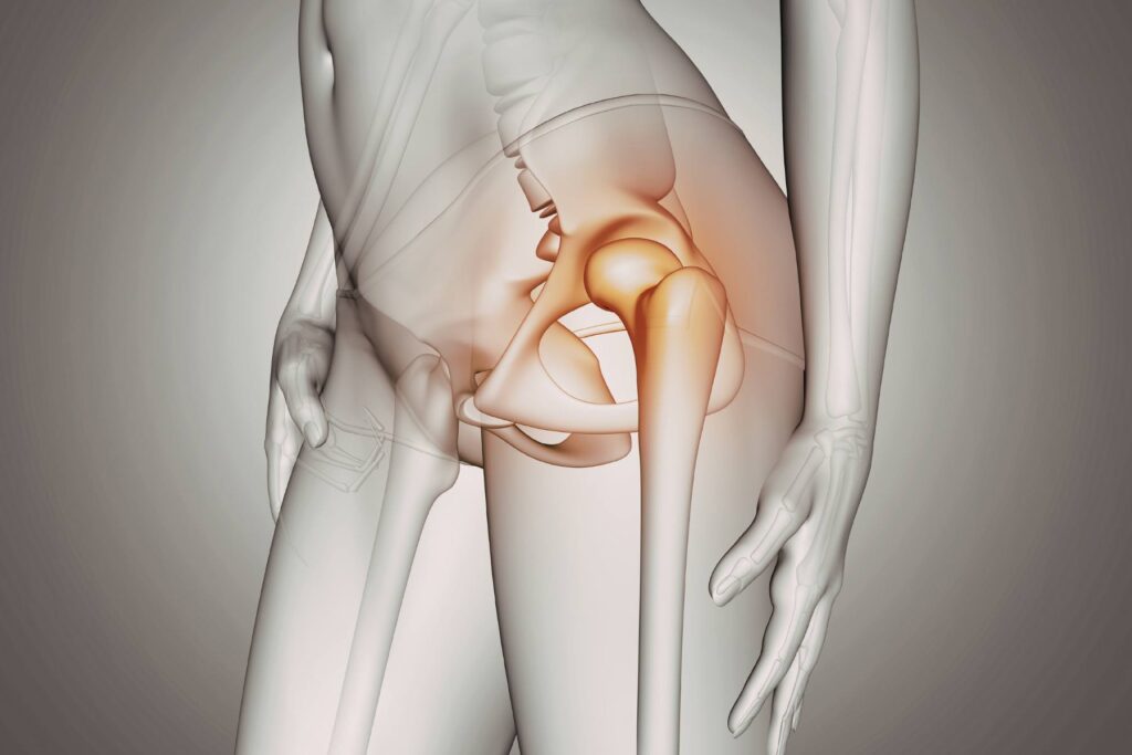 Dismetria dopo protesi anca risarcimento